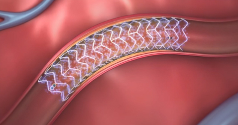 Absorb Dissolving Heart Stent2